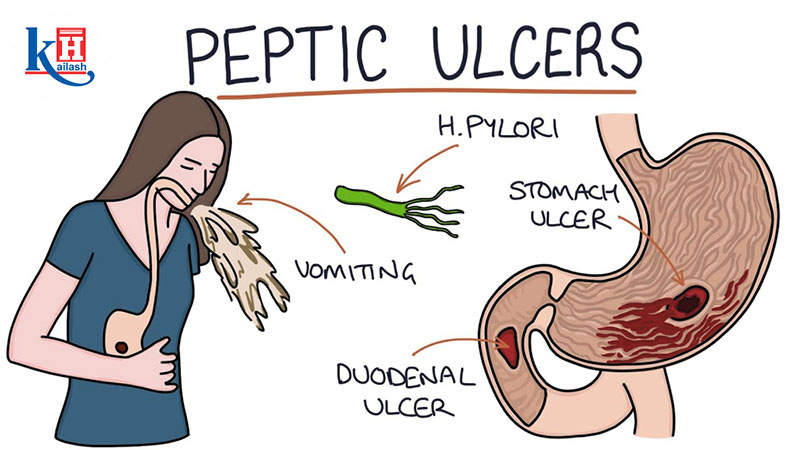 Understanding Peptic Ulcers: Causes, Symptoms, and Treatment Options